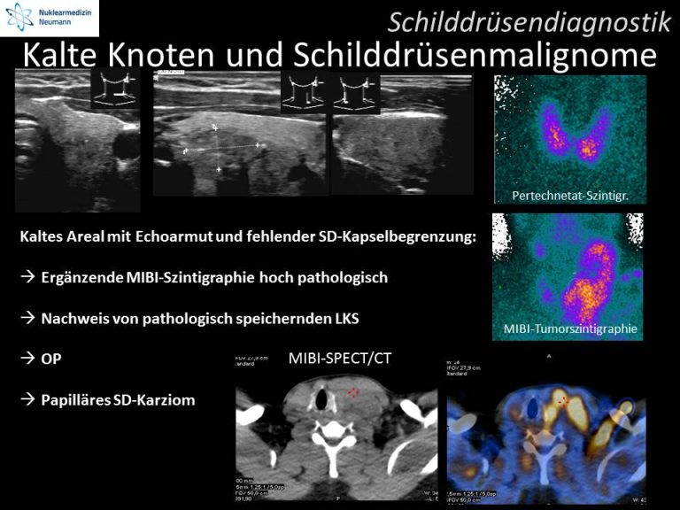Spezielle Schilddrüsendiagnostik bei “kalten” Knoten Nuklearmedizin Neumann Spezielle Schilddrüsendiagnostik bei “kalten” Knoten Nuklearmedizin Neumann