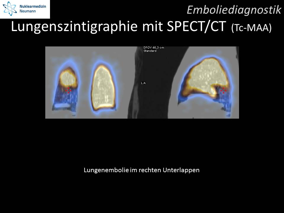 Lungenszintigraphie mit SPECT/CT