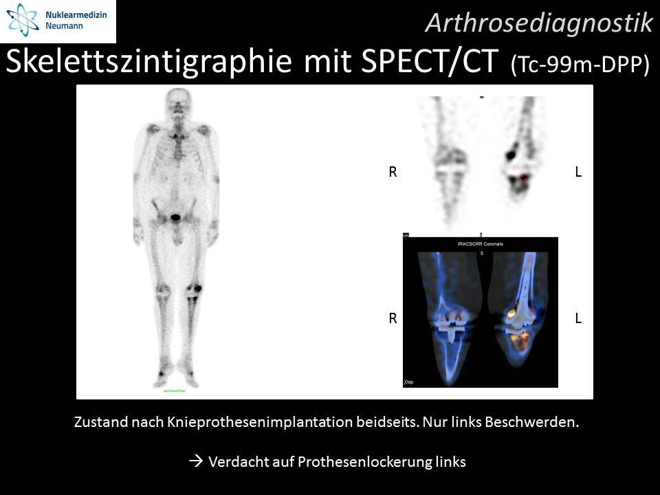 Skelettszintigraphie mit SPECT/CT