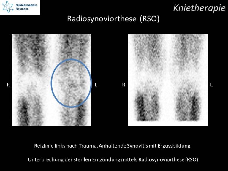 Wie Verhalte Ich Mich Nach Einer Rso