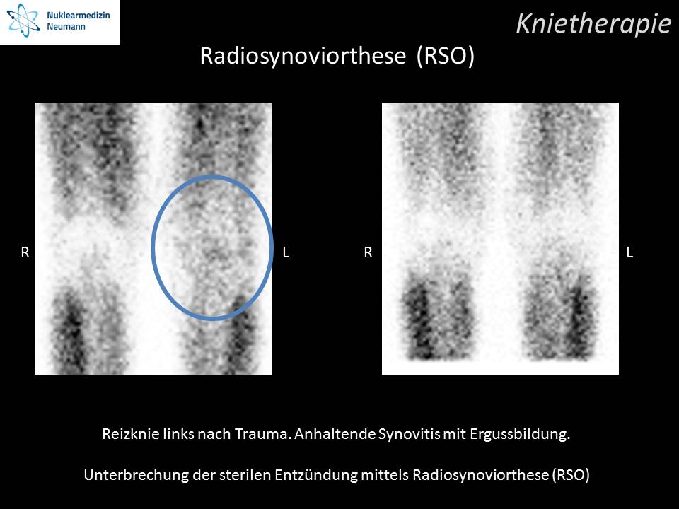 Radiosynoviorthese (RSO)
