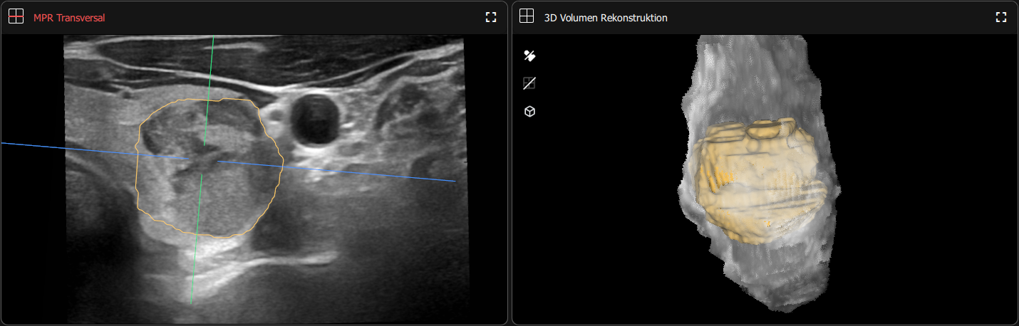 3D-Schilddrüsen-Ultraschall & KI-Analyse